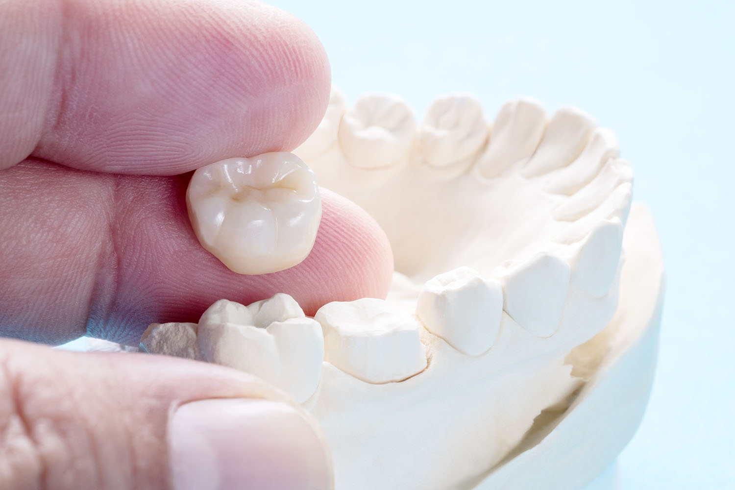 an image of a dental crown