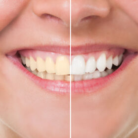 Teeth whitening comparison image