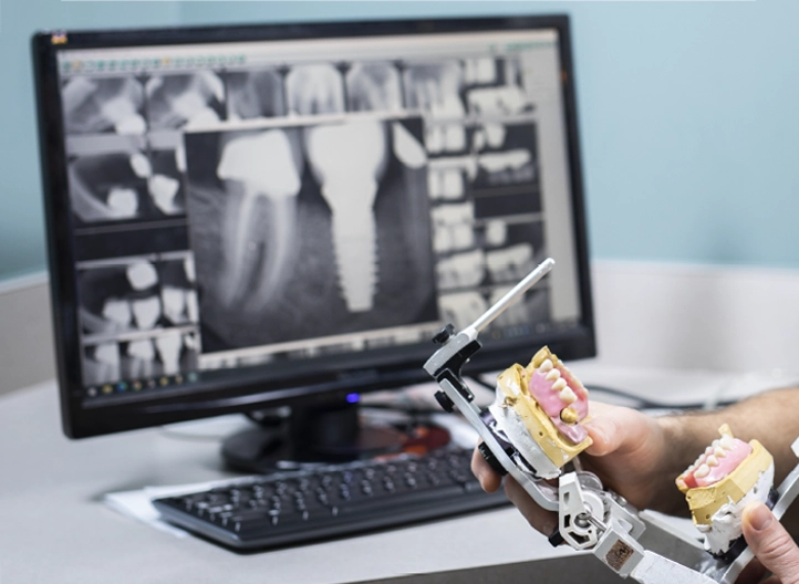Dental implant model and digital X-rays used for treatment planning at a Dayton, Ohio dental office